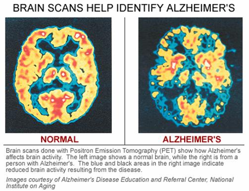 Los escáneres cerebrales de la enfermedad de Alzheimer